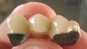 Подробнее о статье Мостовидные протезы в стоматологии – когда они нужны?