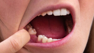 Подробнее о статье Нет одного зуба: варианты восстановления (мостовидный протез)